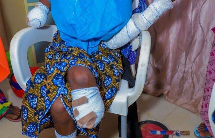 17 Year Old Girl Forced Into Marriage Loses Her Hand And Leg After Her Husband Attacked Her With a Machete in Kebbi (Photos)